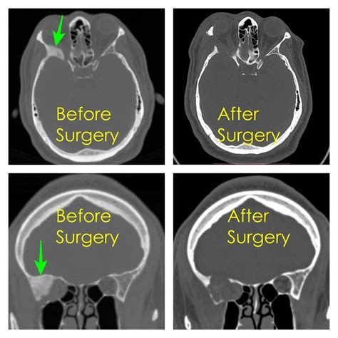 Skull Base Surgery Johannesburg