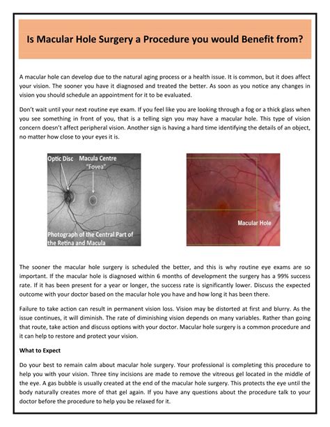 PPT - Is Macular Hole Surgery a Procedure you would Benefit from PowerPoint Presentation - ID ...