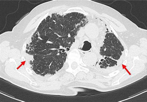 Acute interstitial pneumonitis causes, symptoms, diagnosis, treatment & prognosis