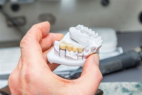 There are Four Types of Dental Bridges to Fill Gaps in Your Teeth