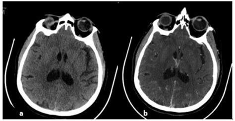 Imaging of Cerebral Venous Thrombosis