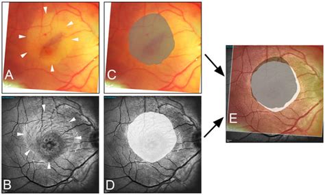 Imaging the Area of Internal Limiting Membrane Peeling after Macular ...