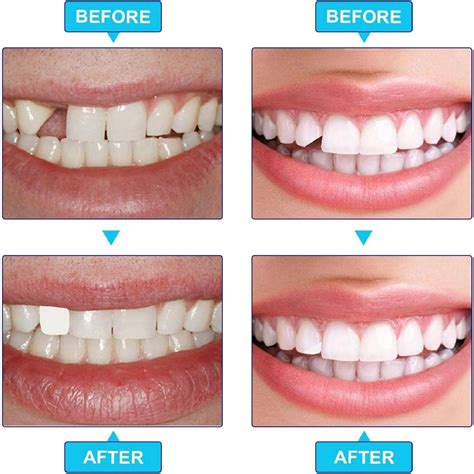 Dental Cap Replacement