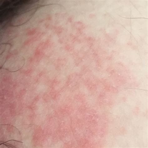 Diaper Contact Dermatitis Icd 10 at Walter Lawrence blog