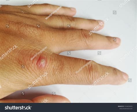 Finger Infection On Knuckle