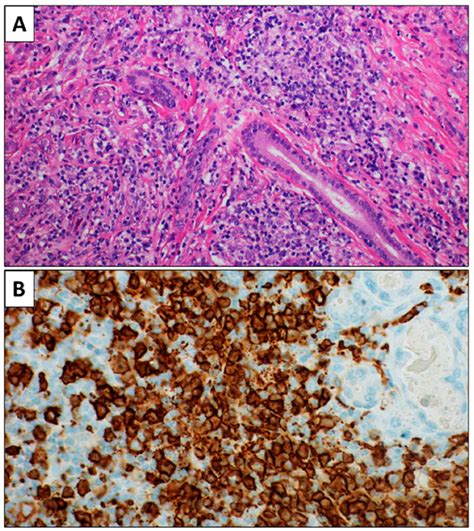 Primary Extra-Nodal DLBCL of Glands: Our Experiences outside Guidelines ...
