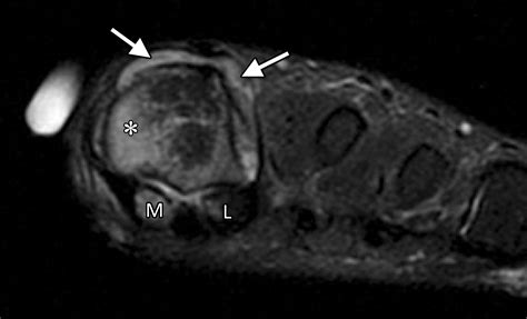 High-Resolution MRI of the First Metatarsophalangeal Joint: Gross ...