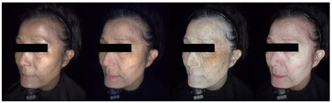 Riehl’s Melanosis: A Multimodality, In Vivo, Real-Time Skin Imaging ...