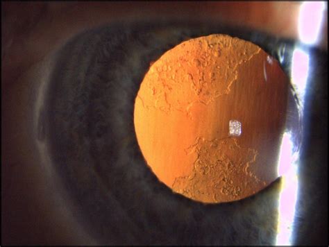 ZEISS SL Imaging Solution | ZEISS Medical Technology