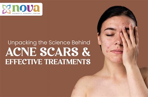 Unpacking the Science Behind Acne Scars and Effective Treatments| Nova ...