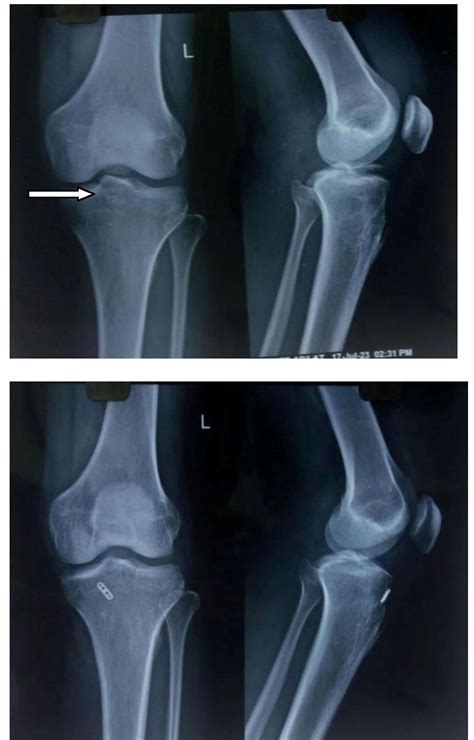Avulsion Fracture Quizlet at Linda Redmon blog