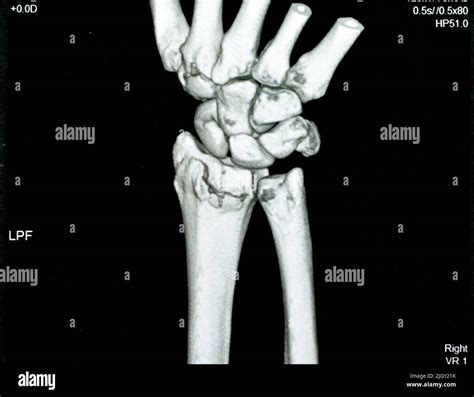 Fractured right wrist x ray hi-res stock photography and images - Alamy