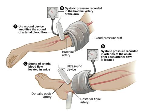 The Ankle-Brachial Index Test: Diagnosing Peripheral Artery Disease and Vascular Health ...