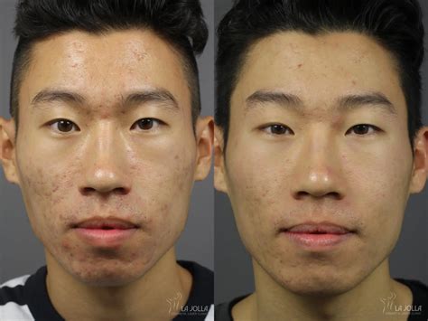Acne: Laser Treatment Before & After Gallery