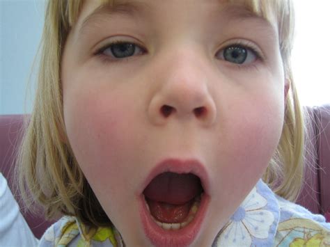 Ptosis | 5.4 | Westmead Eye Manual