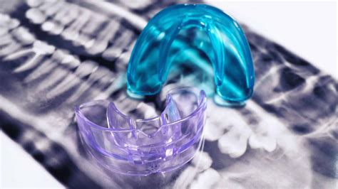 How to Clean a Mouth Guard? Step-by-Step Guide