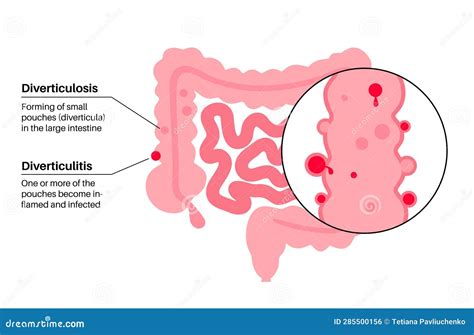 Raisin Bran And Diverticulitis at Wendell Blakely blog