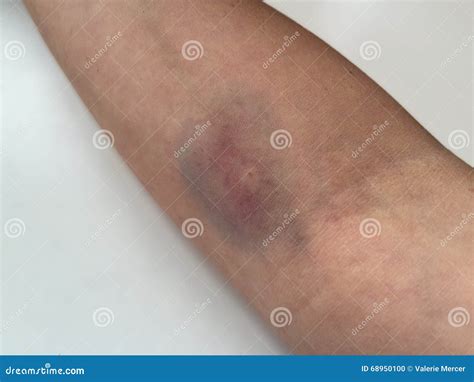 Ruptured vein bruise stock photo. Image of elbow, blood - 68950100