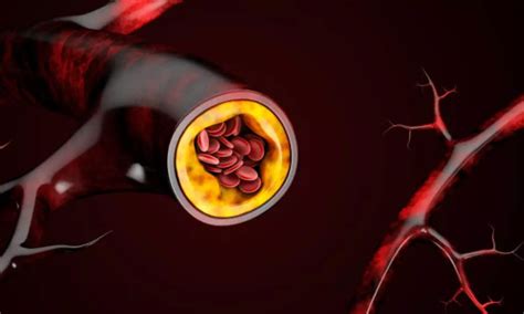 CT CAC useful in identifying which patients may benefit from statin ...