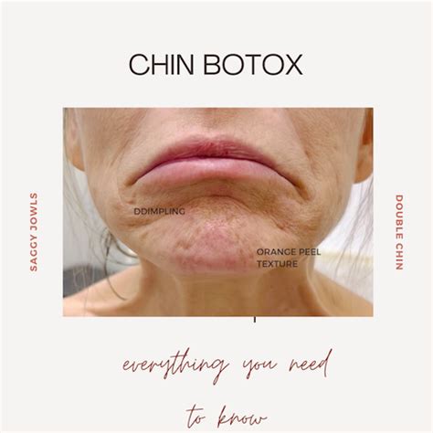 Image result for Chin Botox