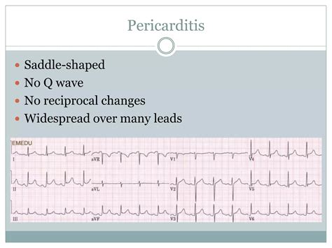 Interpretation of common ecg abnormalities | PPTX