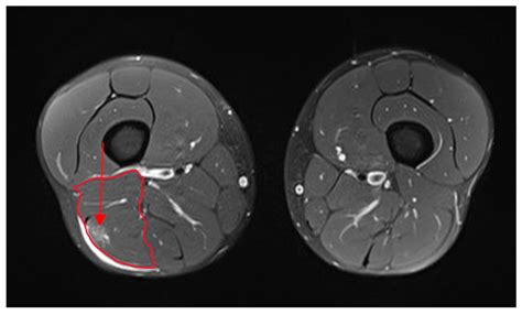 Tensiomyography Allows to Discriminate between Injured and Non-Injured ...