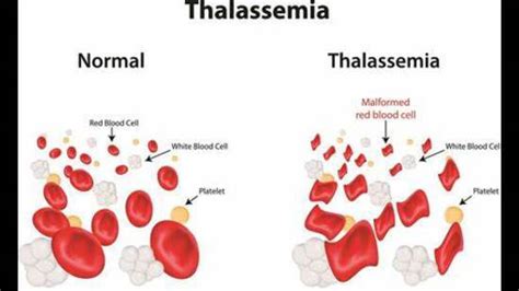 Thalassemia, sickle cell anaemia rates alarmingly high among UP’s Tharu ...