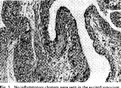 Image result for Extensor Digitorum Communis Surgery