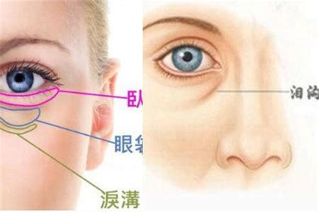 【图】泪沟和眼袋的详细区别图 如何让眼睛更加美丽动人_泪沟_女物美容网|nvwu.com