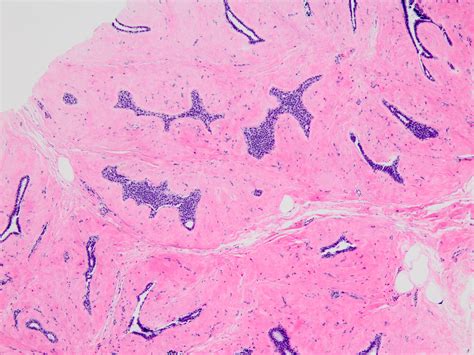 Pathology Outlines - Atypical lobular hyperplasia