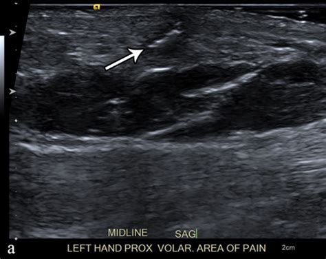 Imaging of Soft-Tissue infections | Encyclopedia MDPI