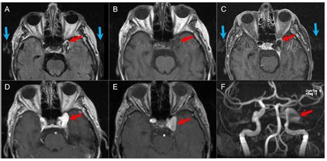 Imaging of Skull Base Tumors