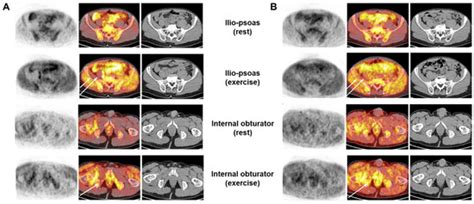 Radiopharmaceuticals for Skeletal Muscle PET Imaging