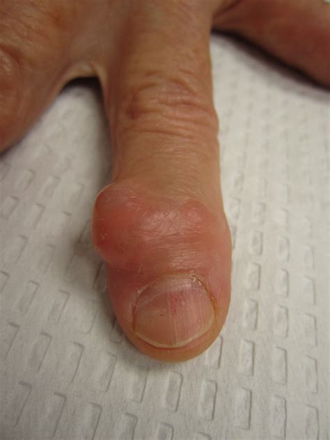 Should A Mucous Cyst On Finger Be Removed - Infoupdate.org