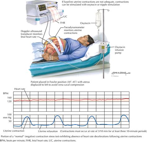 Contraction Stress Testing - Clinical Tree