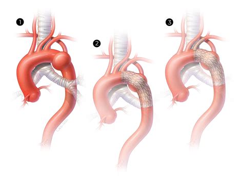 SCVS - Treatment Of Blunt Traumatic Aortic Injury With Aberrant Right ...