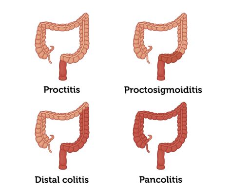 Proctitis vs. Ulcerative Colitis: 5 Facts To Know | MyCrohnsAndColitisTeam