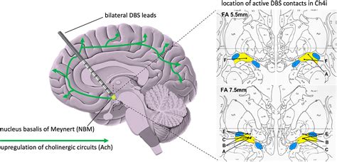 Deep Brain Stimulation of the Nucleus Basalis of Meynert for Parkinson's Disease Dementia: A 36 ...