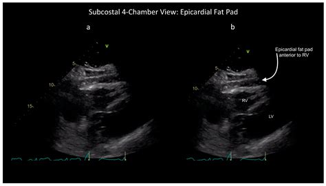 Blood or Fat? Differentiating Hemopericardium versus Epicardial Fat Using Focused Cardiac Ultrasound