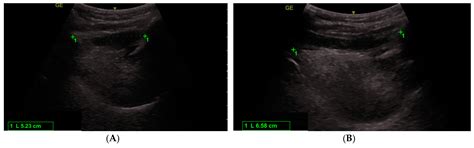 Clinical versus Ultrasound Measurements of Hyomental Distance Ratio for ...