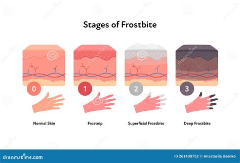 Frostbite Anatomical Infographic. Vector Flat Healthcare Illustration ...