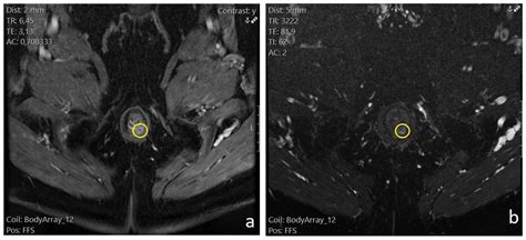 Fistula In Ano Mri