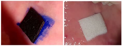 A Comparison of Clinical Efficiency of Photodynamic Therapy and Topical ...