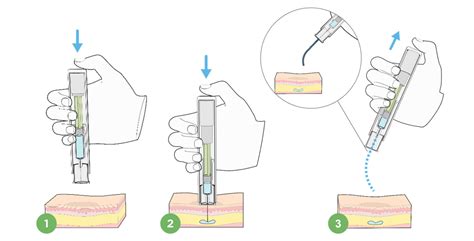 Image result for Spring Based Non-Invasive Injection