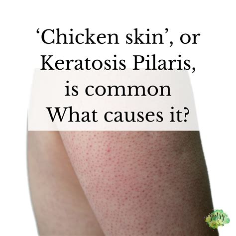 Keratosis Pilaris or 'chicken skin' is common. What causes it? — Gutsy By Nutrition | Health ...