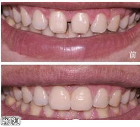 口腔科谱 | 需要矫正的七种牙齿-蜜颜优惠