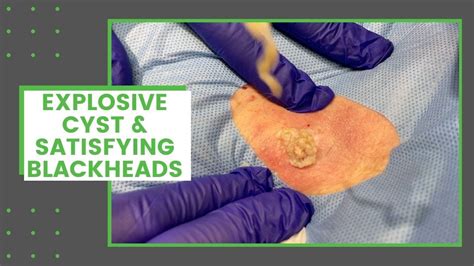 Image result for Largest Infected Exploding Cyst Carbuncle Blackhead
