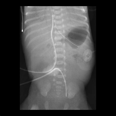 Premature newborn after umbilical arterial catheter placement | Pediatric Radiology Case ...