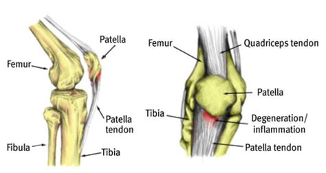 What Is Jumper’s Knee? | Zanskar Health Blog