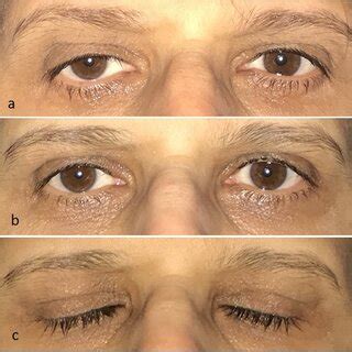 Image result for Levator Resection Surgery